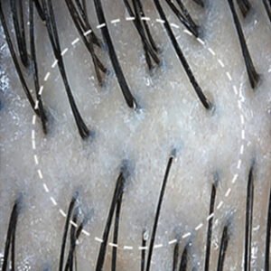 scalp redness after image