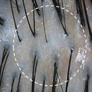 scalp redness before image